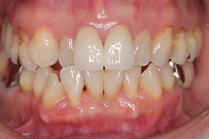 黒ずみのある前歯をセラミックで美しく 治療後画像