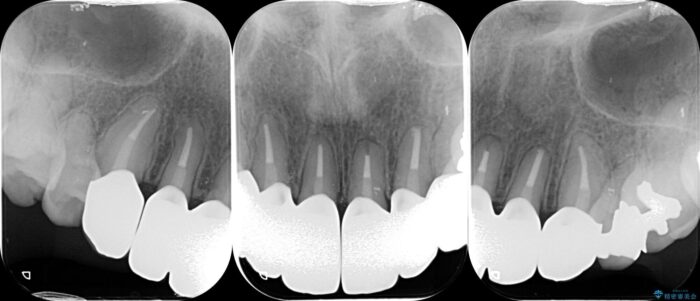 前歯のセラミックと歯周外科治療 治療後画像