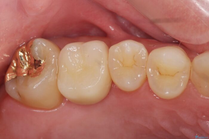 骨が足りない上あごへの骨造成を伴うインプラント治療 治療後画像