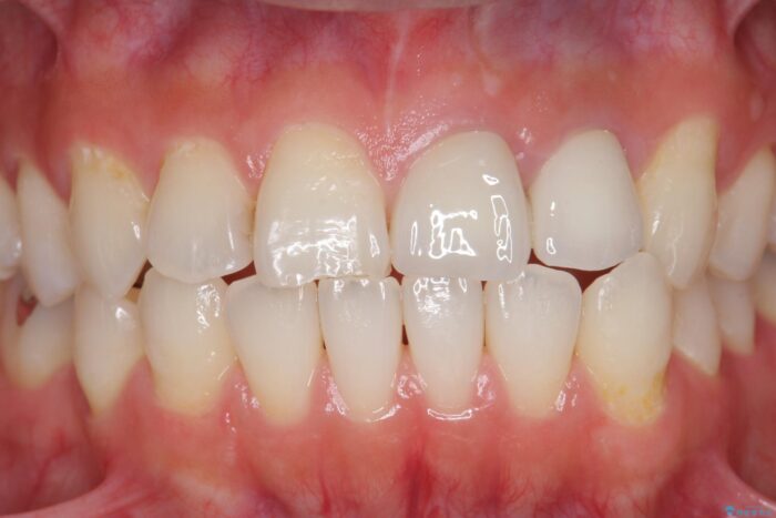 前歯のセラミック治療 治療後画像