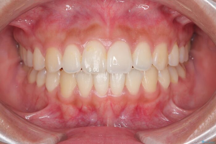 すきっ歯をワイヤー矯正で改善 治療後画像