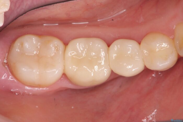 銀歯の下の虫歯治療と歯周外科治療 治療後画像