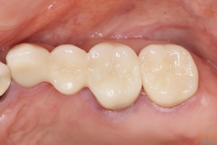 セラミックブリッジで銀歯を白く 治療後画像