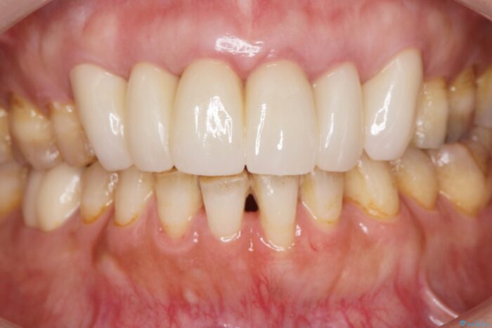 前歯のセラミックと歯周外科治療 治療後画像