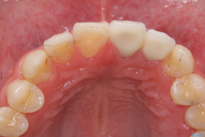 前歯のセラミック治療 治療後画像