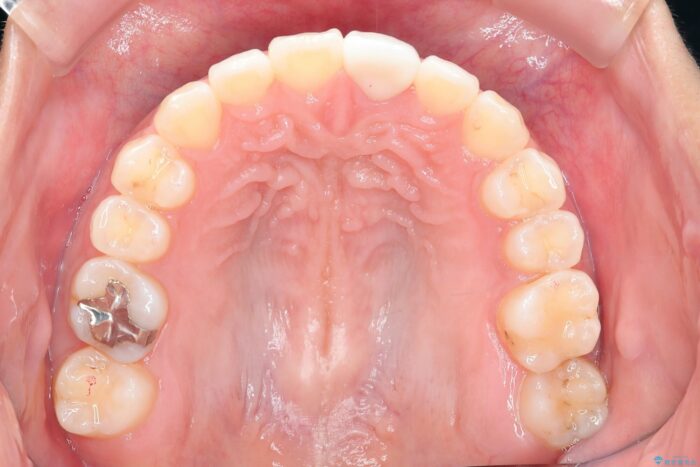 すきっ歯をワイヤー矯正で改善 治療後画像