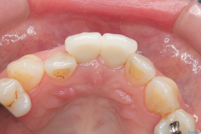 黒ずみのある前歯をセラミックで美しく 治療後画像