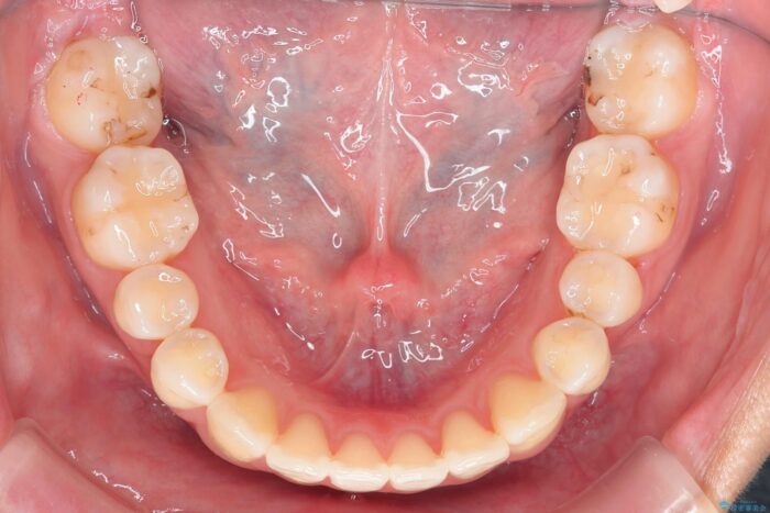 すきっ歯をワイヤー矯正で改善 治療後画像