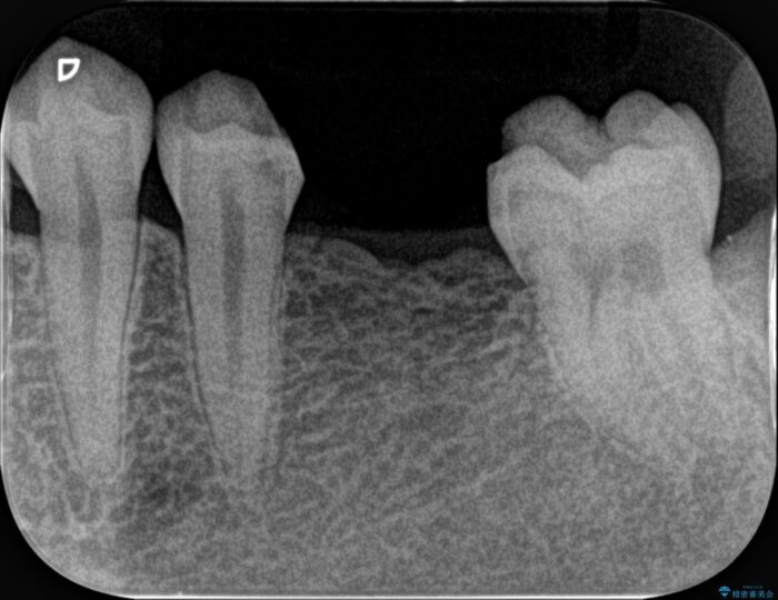 虫歯の再発リスクの少ないジルコニアブリッジ治療 治療前画像