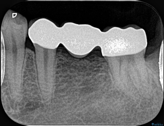 虫歯の再発リスクの少ないジルコニアブリッジ治療 治療後画像